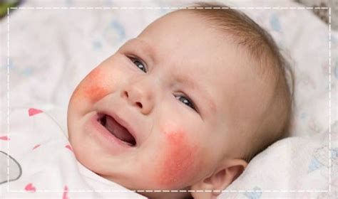 Bebeklerde susam alerjisi belirtileri